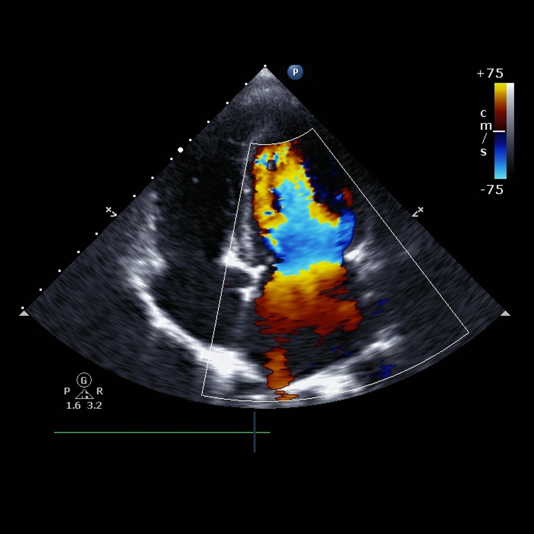 Echocardiogram